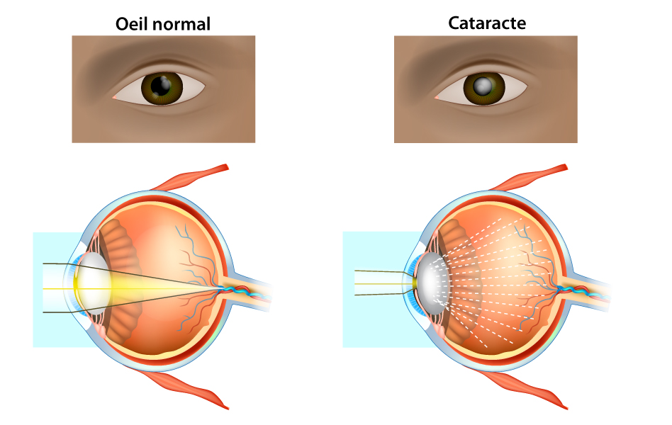 Chirurgie de la cataracte